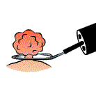 大腸ポリープ切除